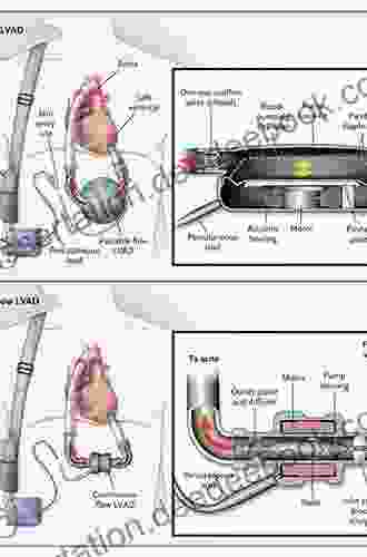 Ventricular Assist Devices In Advanced Stage Heart Failure